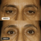 Micro - Infusion System For Upper Eyelids - Botanique Paris