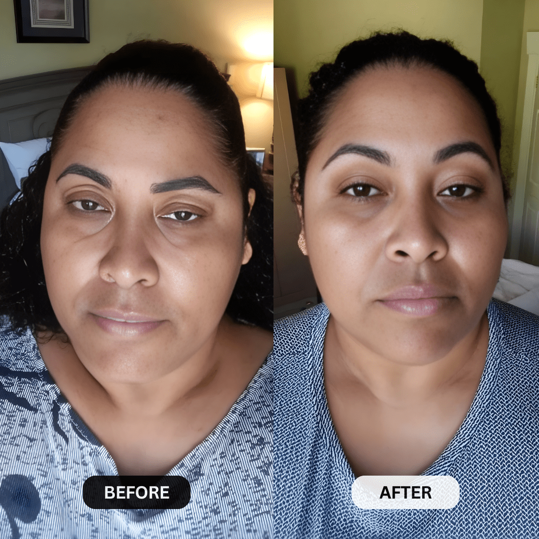 Micro - Infusion System For Upper Eyelids - Botanique Paris