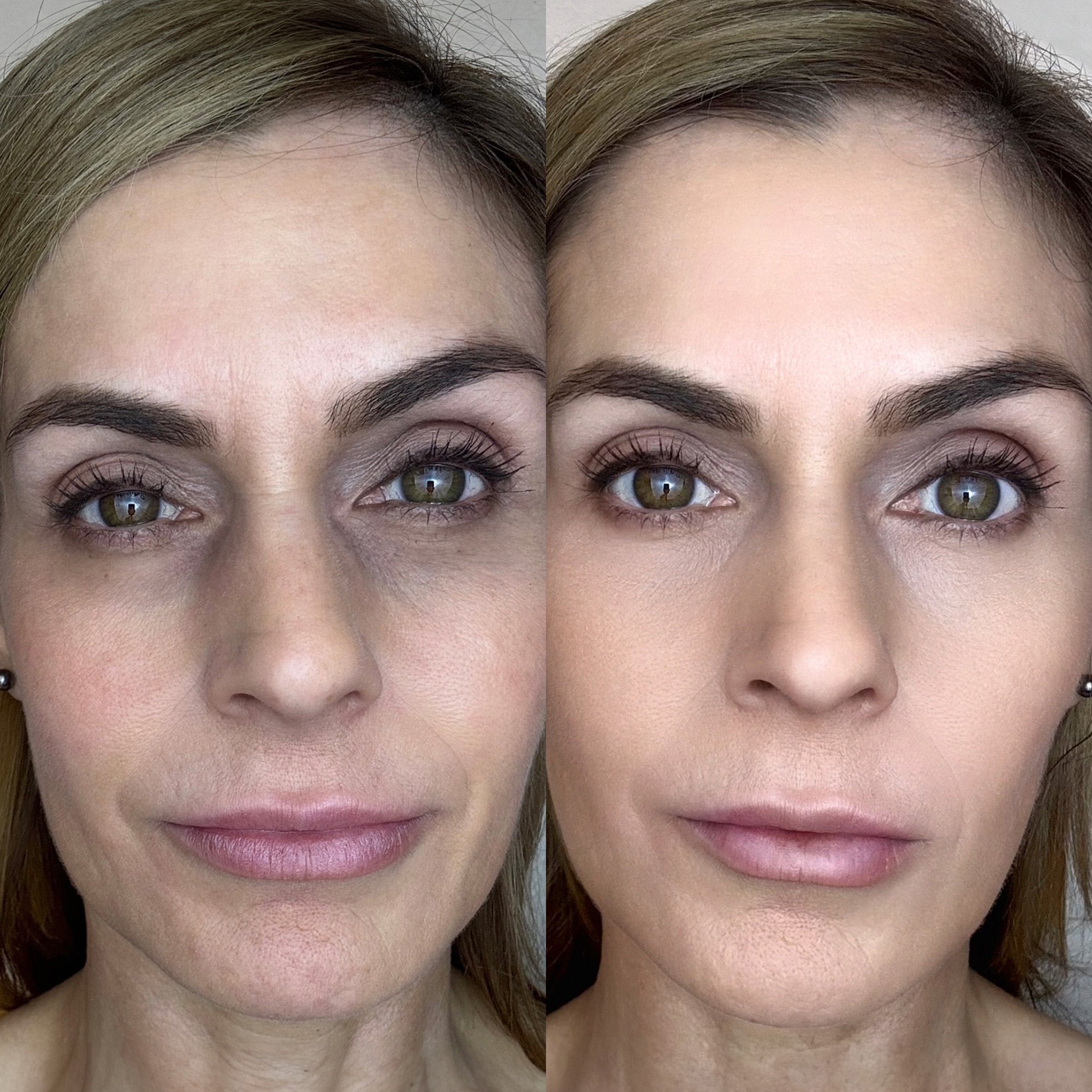 Michelle M Botanique Paris before and after RevitalEyes treatment