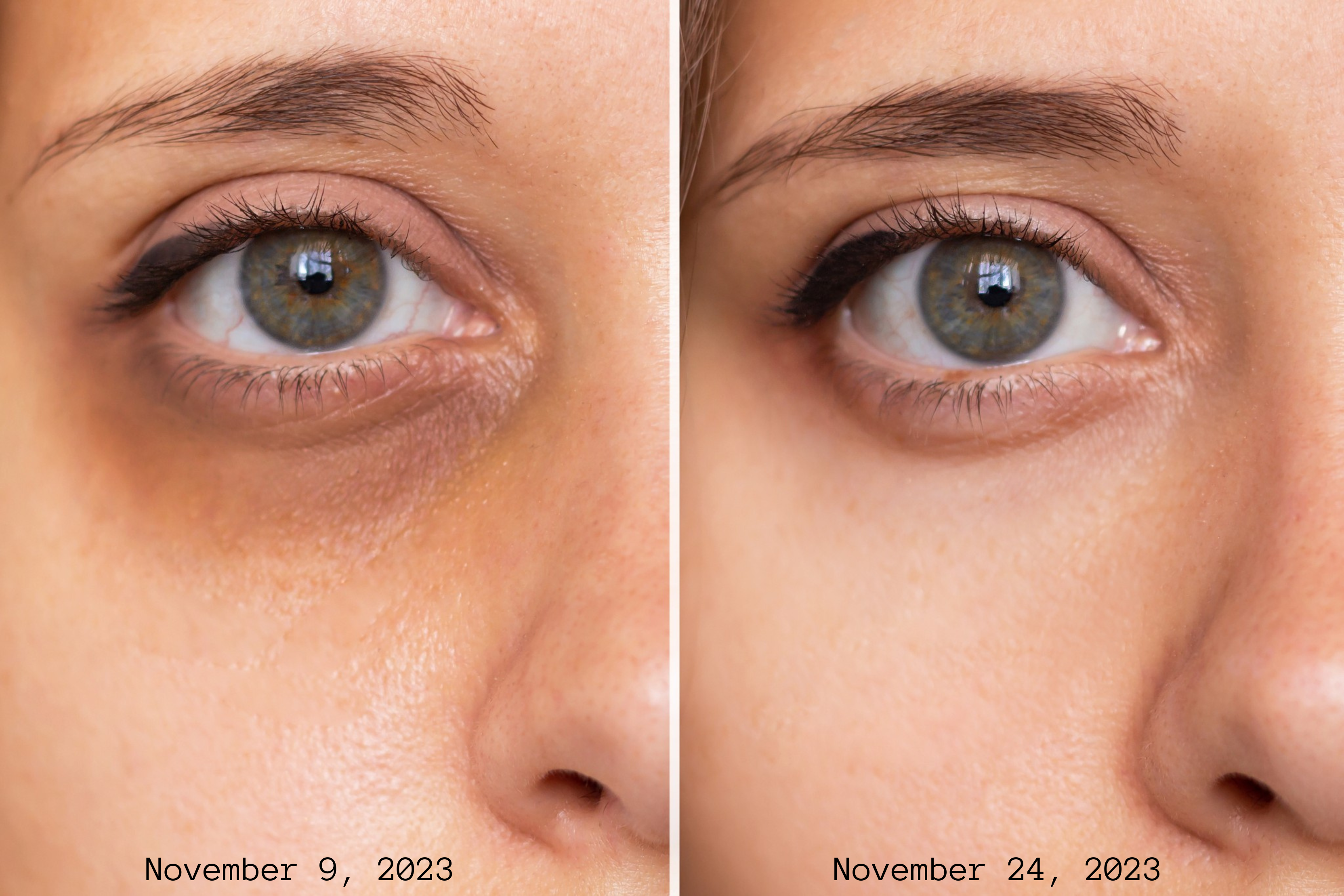 Eradicate Under-Eye Concerns Fast