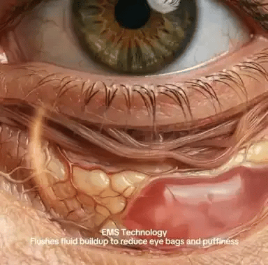 It uses electric muscle stimulation to flush the stuck fluid causing your eye bags