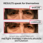 RevitalEyes® Korean Dermal Red Light Therapy + EMS To Erase Eye Wrinkles & Fine Lines - Botanique Paris