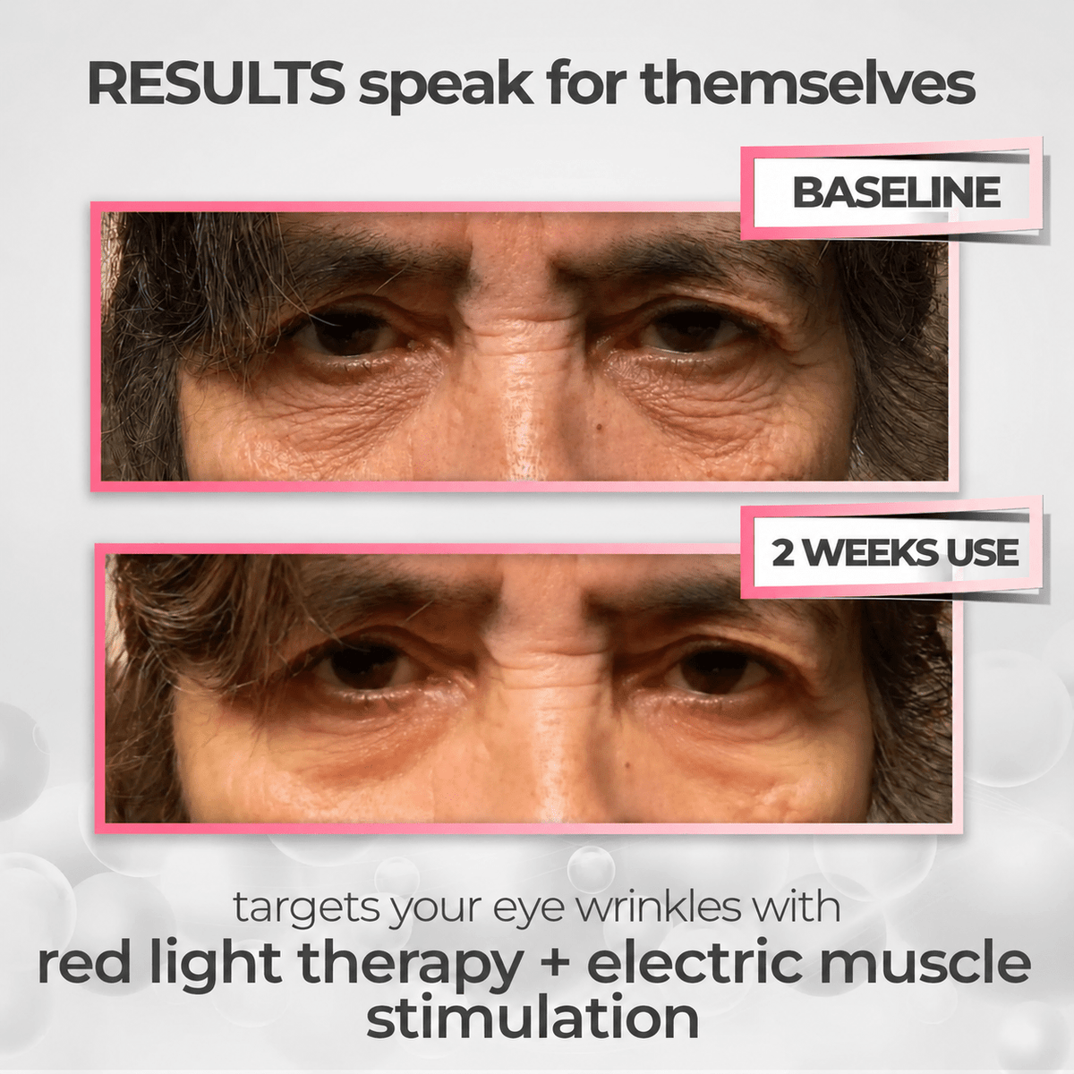 RevitalEyes® Korean Dermal Red Light Therapy + EMS To Erase Eye Wrinkles & Fine Lines - Botanique Paris