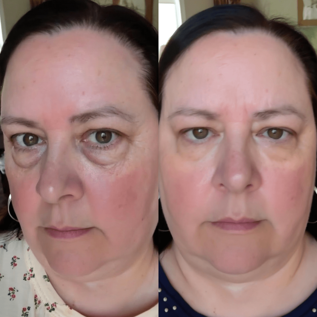 RevitalEyes® — Red Light & EMS Device for Hormone - Related Under - Eye Puffiness - Botanique Paris