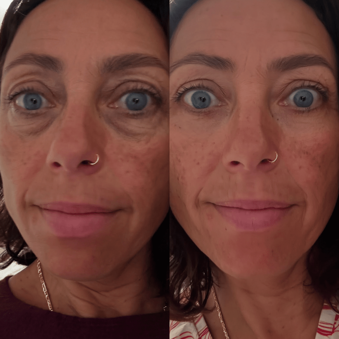 RevitalEyes® — Red Light & EMS Device for Hormone - Related Under - Eye Puffiness - Botanique Paris