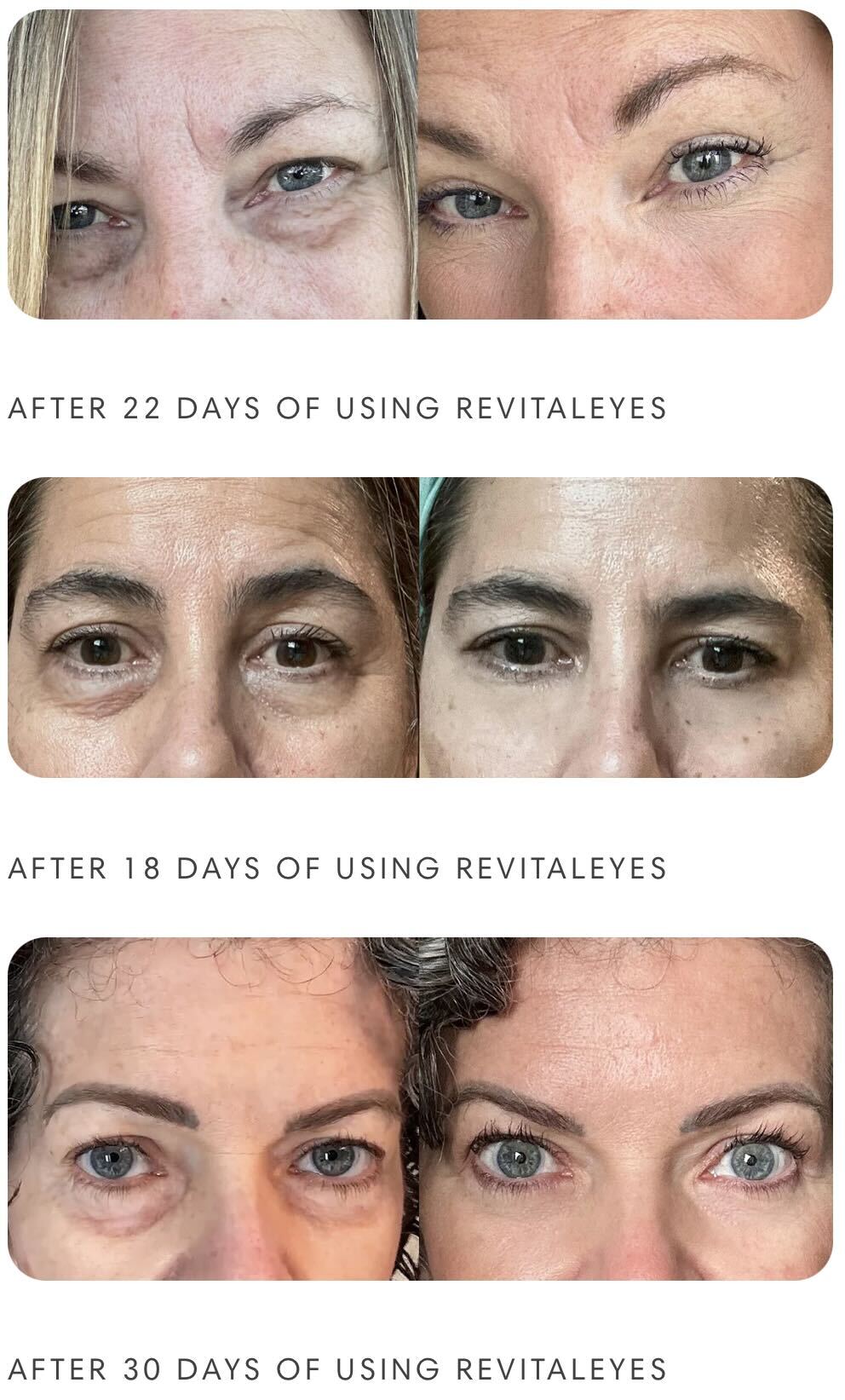 Before and after effects of using Revitaleyes on a woman's eyes over 30 days.