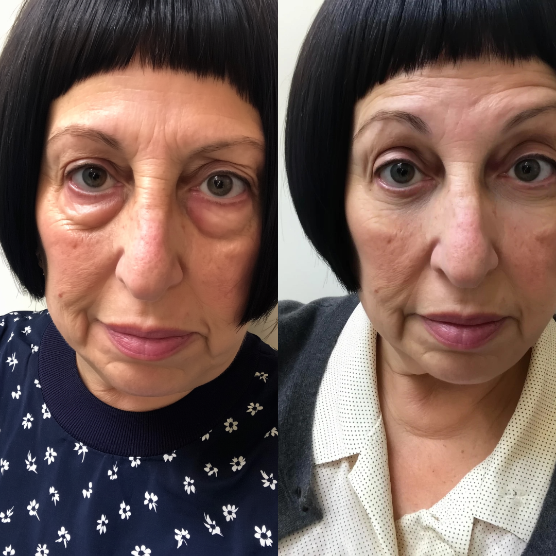 after/before
