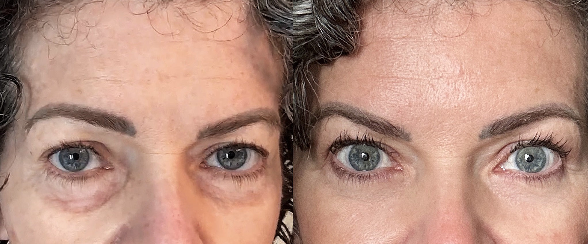 Before and after comparison of a woman's eyes with visible aging changes.