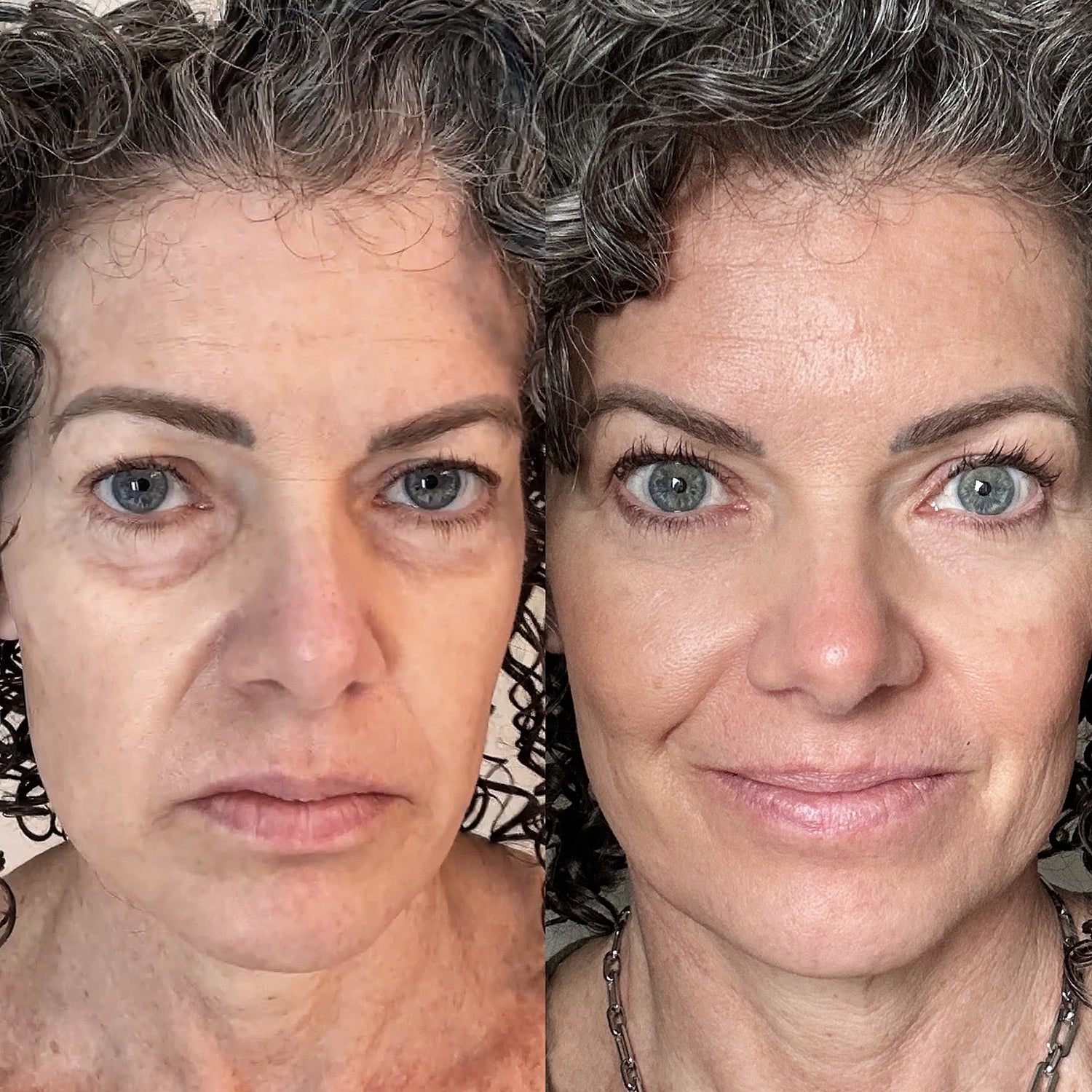 Before and After