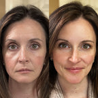 Multi - Spectral Chin & Neck Tightening Light Therapy® Device - Botanique Paris