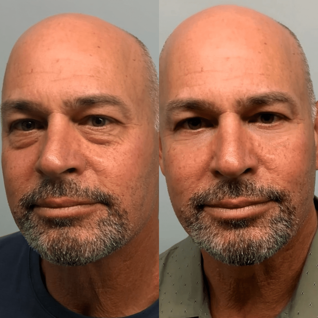 RevitalEyes® 2 - in - 1 Red Light Therapy + EMS To Erase Eye Bags - Botanique Paris