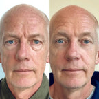 RevitalEyes® 2 - in - 1 Red Light Therapy + EMS To Erase Eye Bags - Botanique Paris