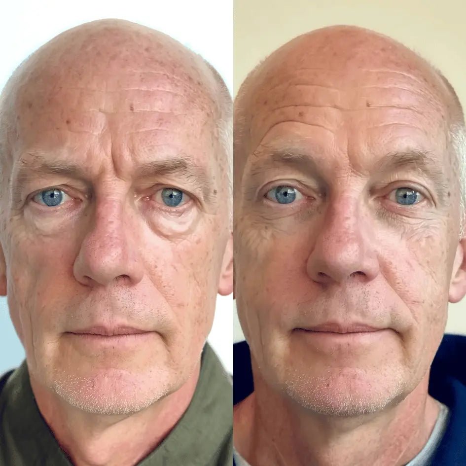 RevitalEyes® 2 - in - 1 Red Light Therapy + EMS To Erase Eye Bags - Botanique Paris