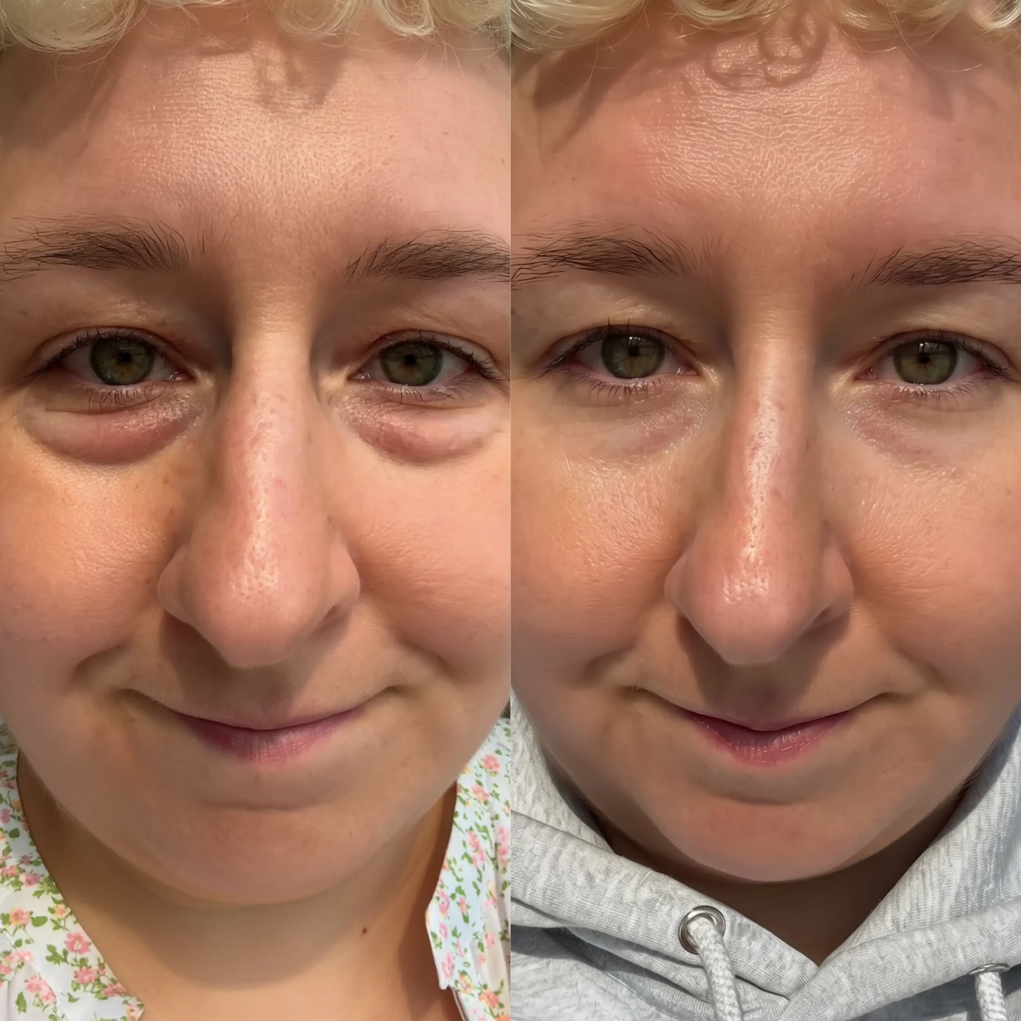 RevitalEyes® 2-in-1 Red Light Therapy + EMS To Erase Eye Bags 30-39 - Botanique Paris