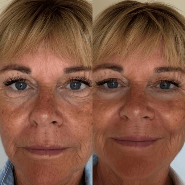 RevitalEyes® 2-in-1 Red Light Therapy + EMS To Get Rid of Tear Troughs - Botanique Paris