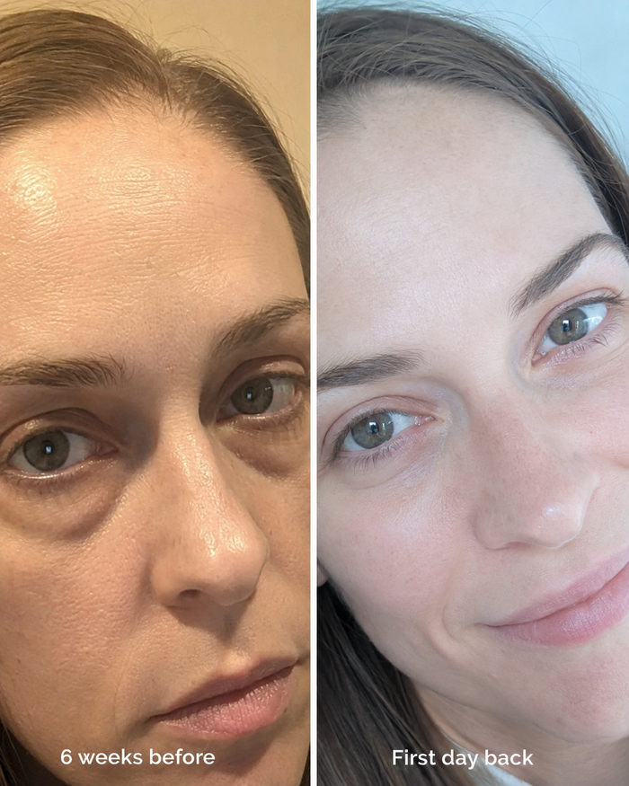 Korean dermal technology costs significantly less than a single filler session