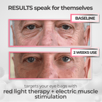 RevitalEyes® 2 - in - 1 Red Light Therapy + EMS To Erase Eye Bags - Botanique Paris