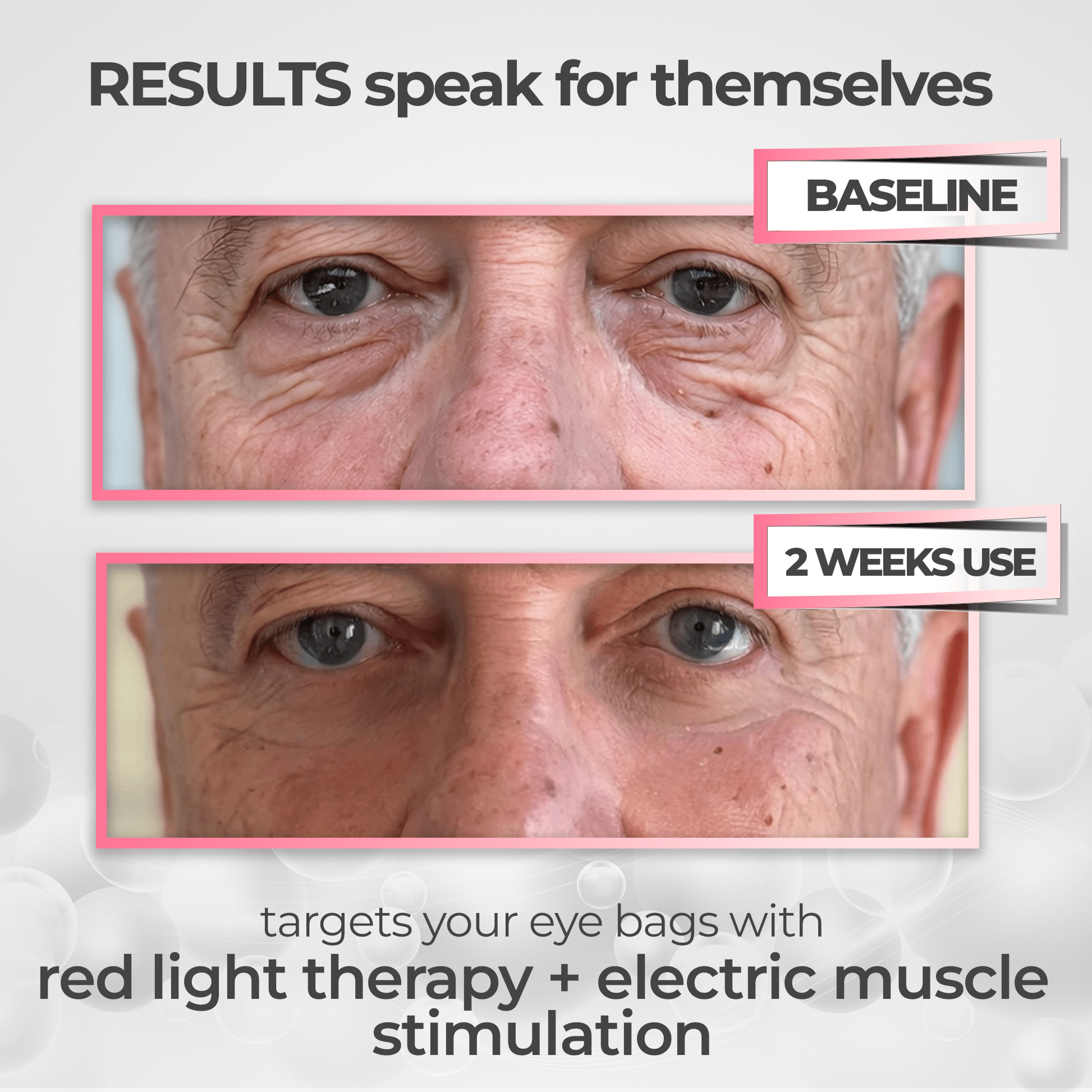 RevitalEyes® 2 - in - 1 Red Light Therapy + EMS To Erase Eye Bags - Botanique Paris