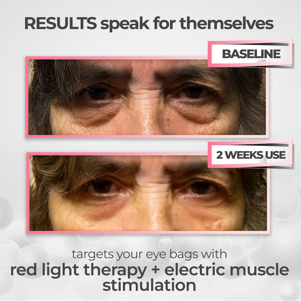 RevitalEyes® 2 - in - 1 Red Light Therapy + EMS To Erase Eye Bags - Botanique Paris