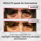 RevitalEyes® 2 - in - 1 Red Light Therapy + EMS To Erase Eye Bags - Botanique Paris