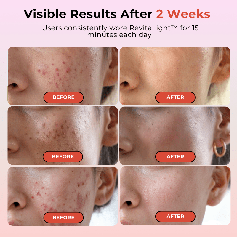 Revitalight RevitaLight™ Red Light Therapy Face Mask | Botanique Paris