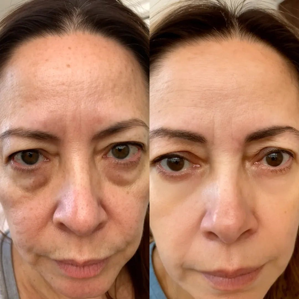 RevitalEyes® 2 - in - 1 Red Light Therapy + EMS To Erase Eye Bags - Botanique Paris