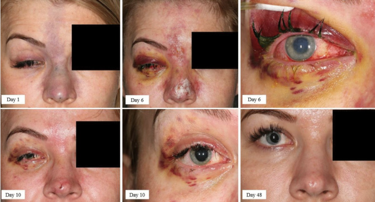 Progressive stages of an eye injury over time with close-up views on a grid.