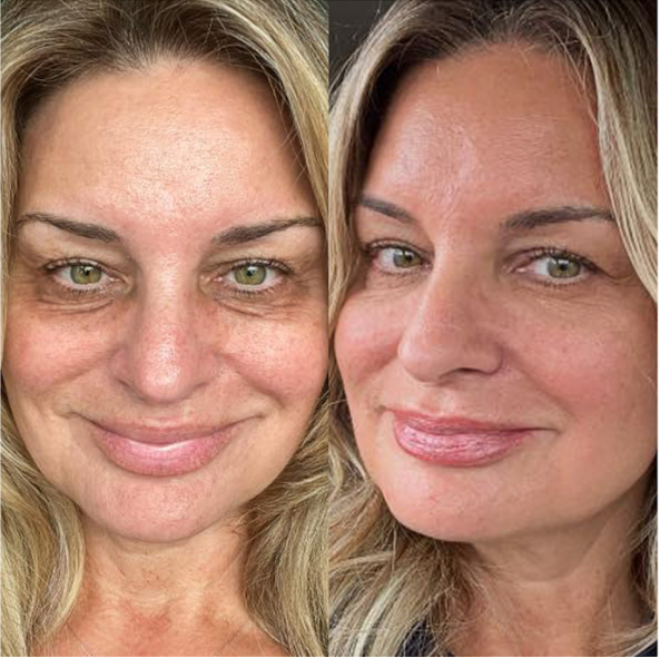 Before and after comparison of a woman's face with visible aging changes.