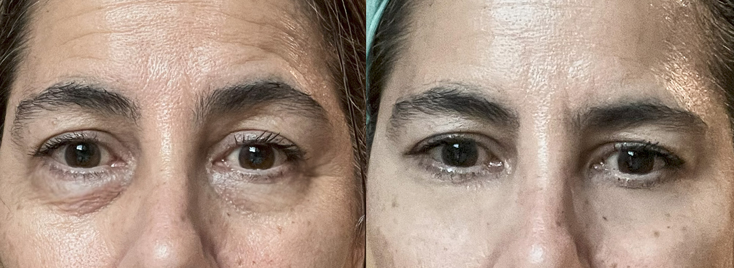 Before and after comparison of a woman's face with visible skin texture and lines.