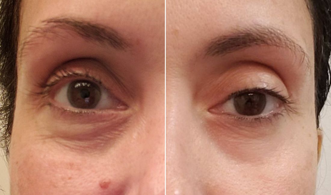 before and after Sofie Botanique Paris