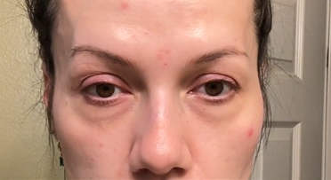 Close-up of a person's face with visible skin imperfections.