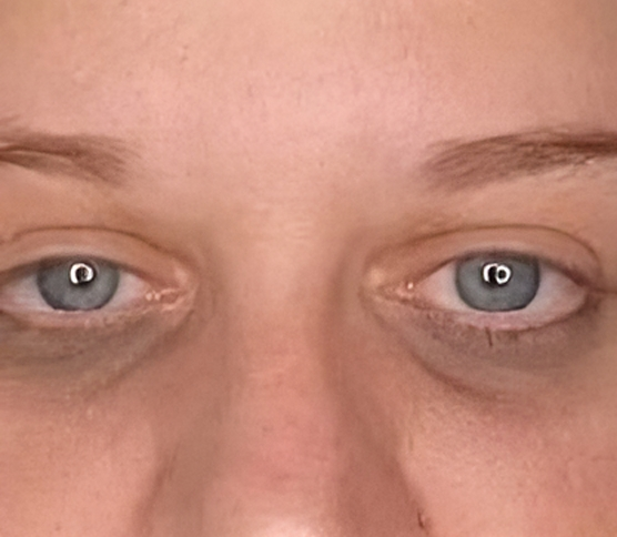 Dark Eye Circles