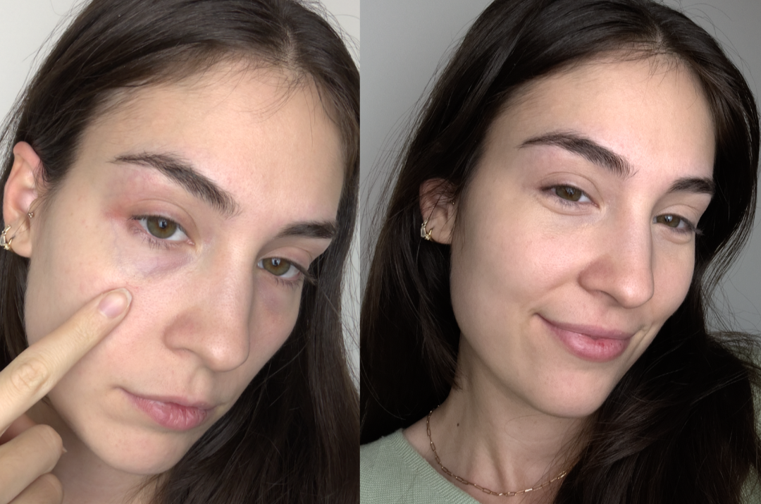 Reduce Puffiness and Dark Circles