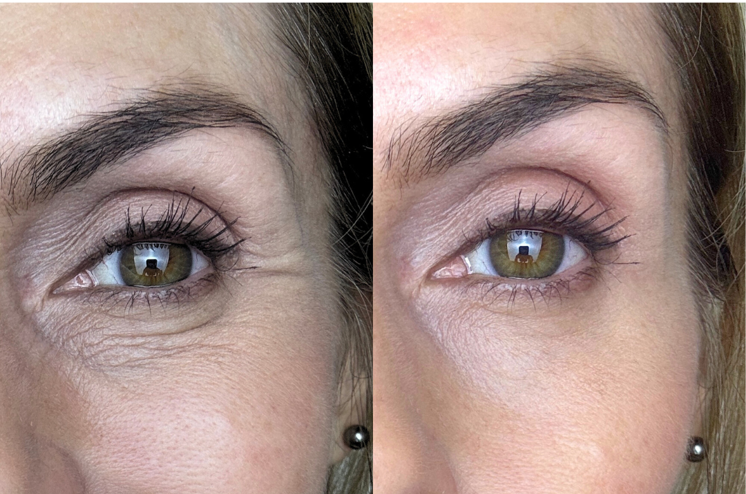 Fight Fine Lines and Wrinkles