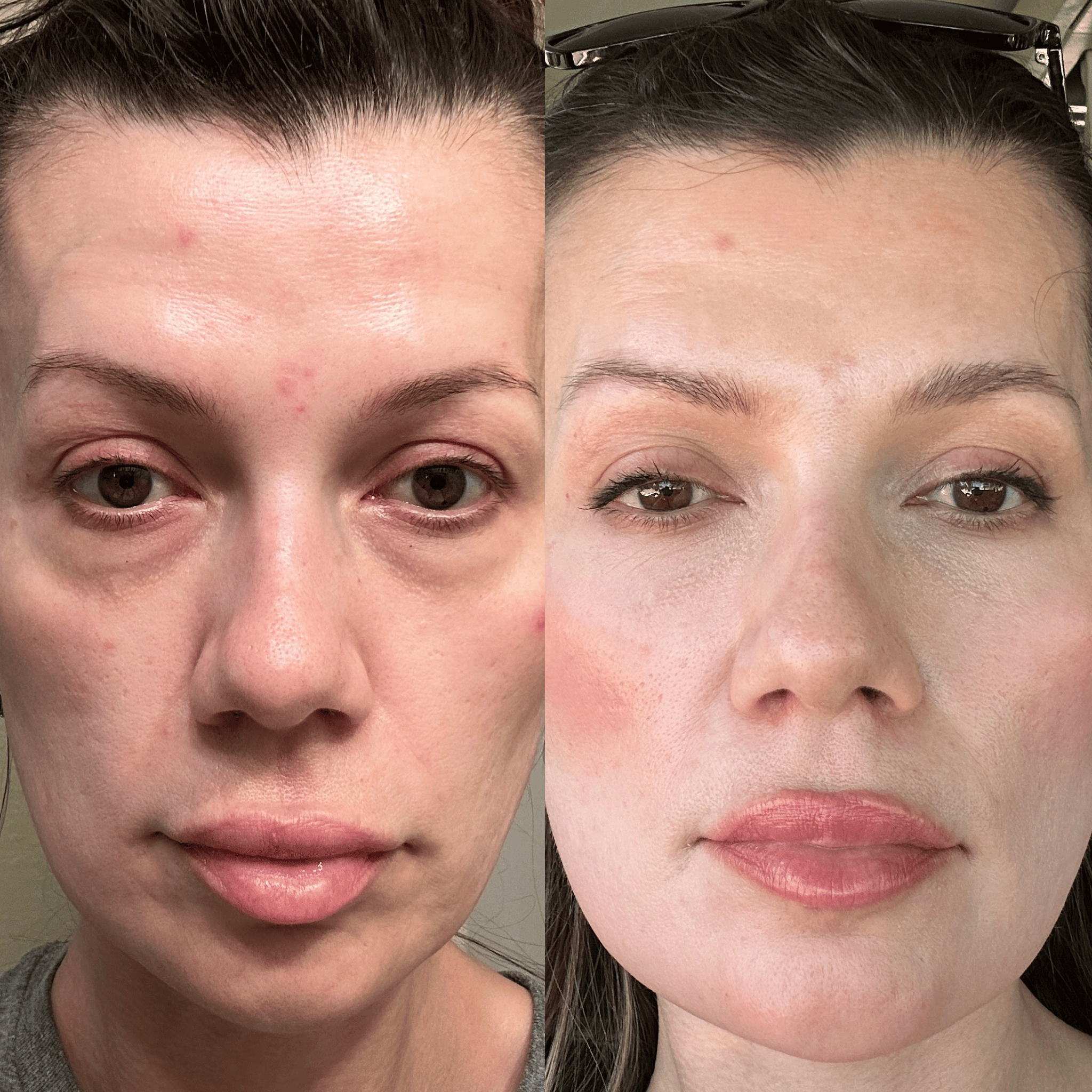 RevitalEyes® Under - Eye Red Light Therapy for Men - Botanique Paris