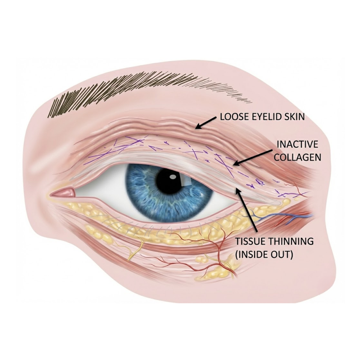 Medical visualization: the three causes of upper eyelid hooding