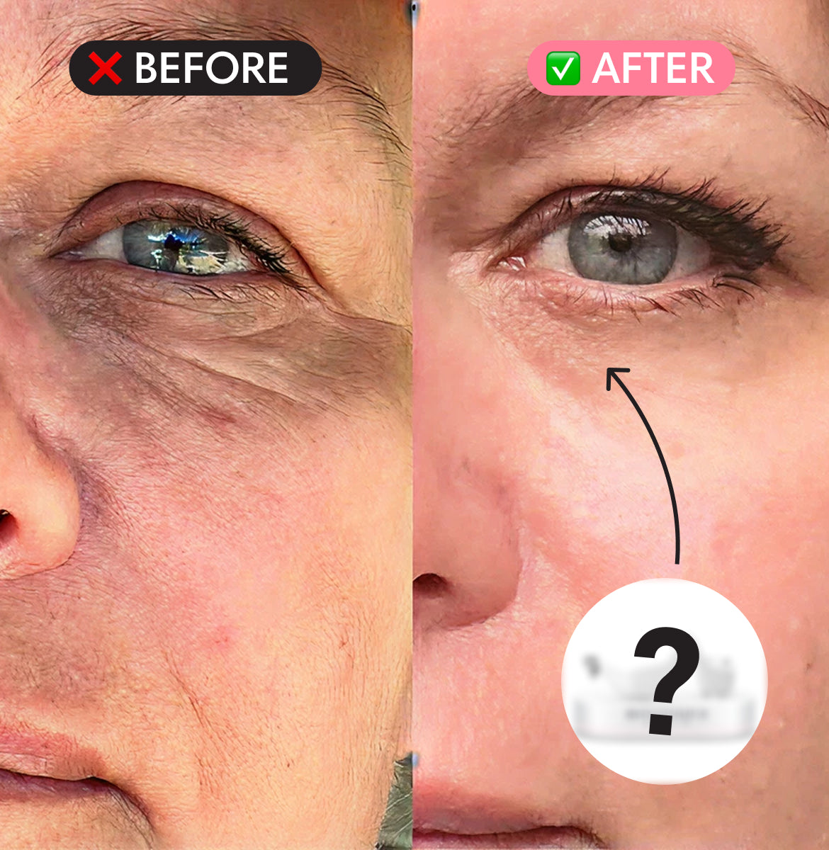 Dark Circles from Low Iron