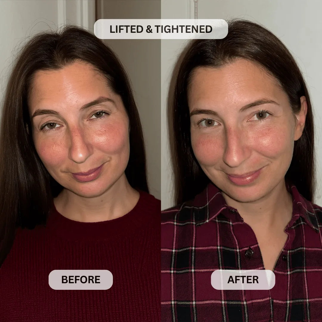 Upper eyelid before and after