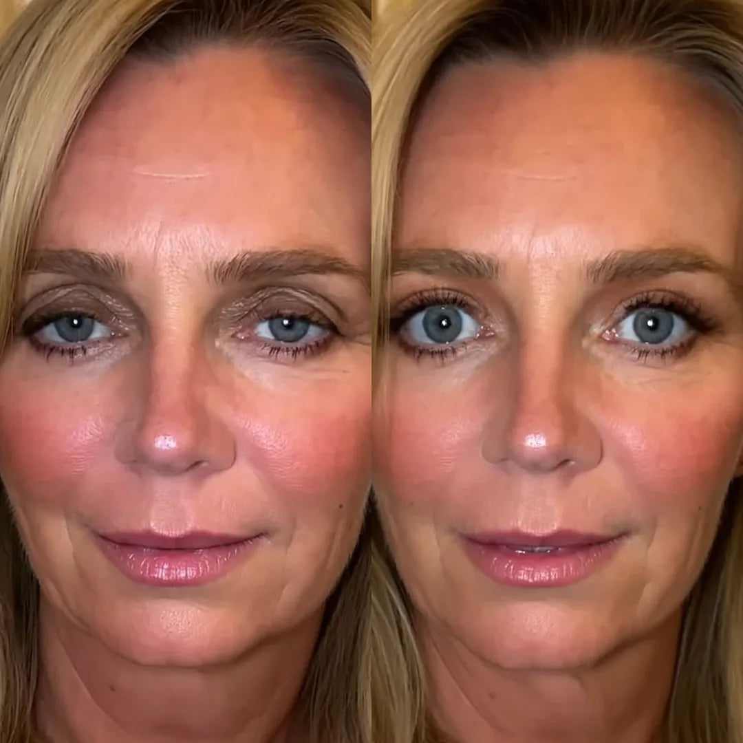 Before and after, upper eyelids