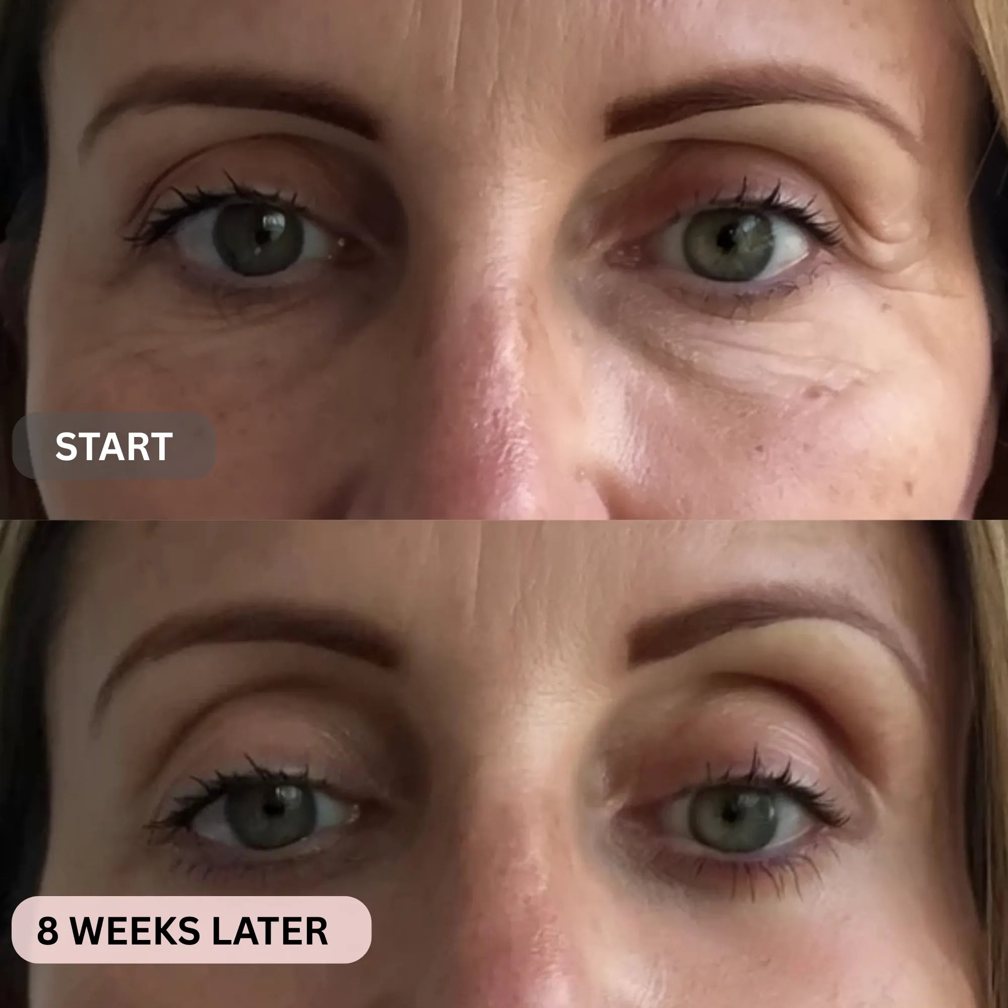 Micro - Infusion System For Under Eyes (Women) - Botanique Paris