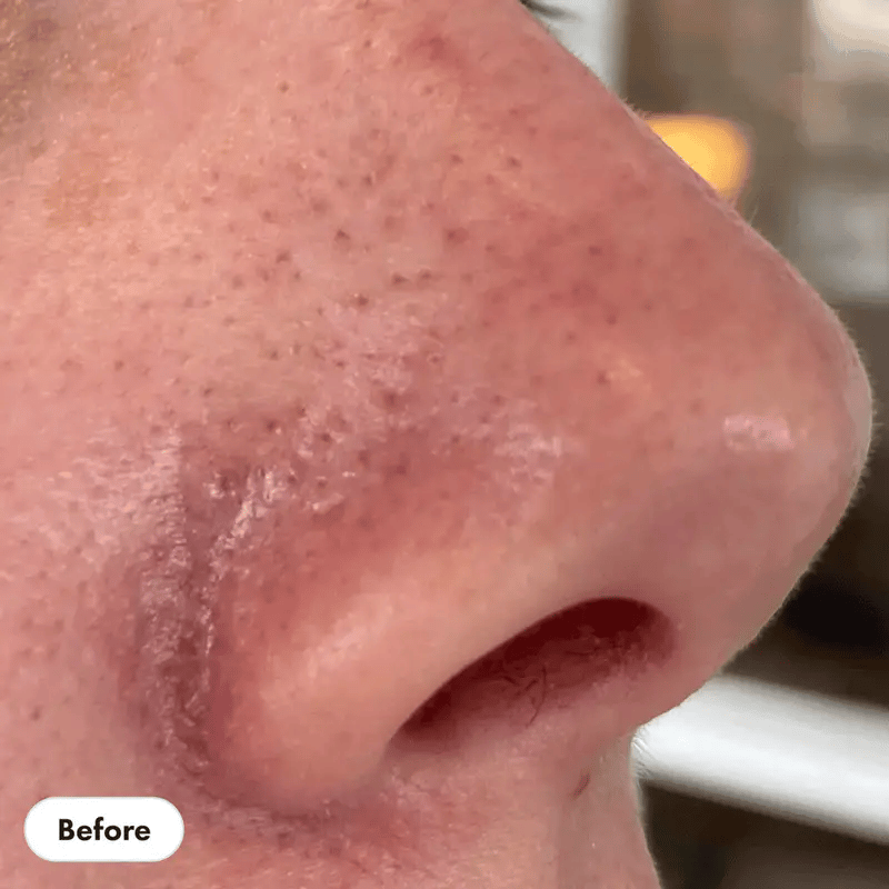 Say Goodbye to Stubborn Pore Issues: HydraClear™ Has the Answer