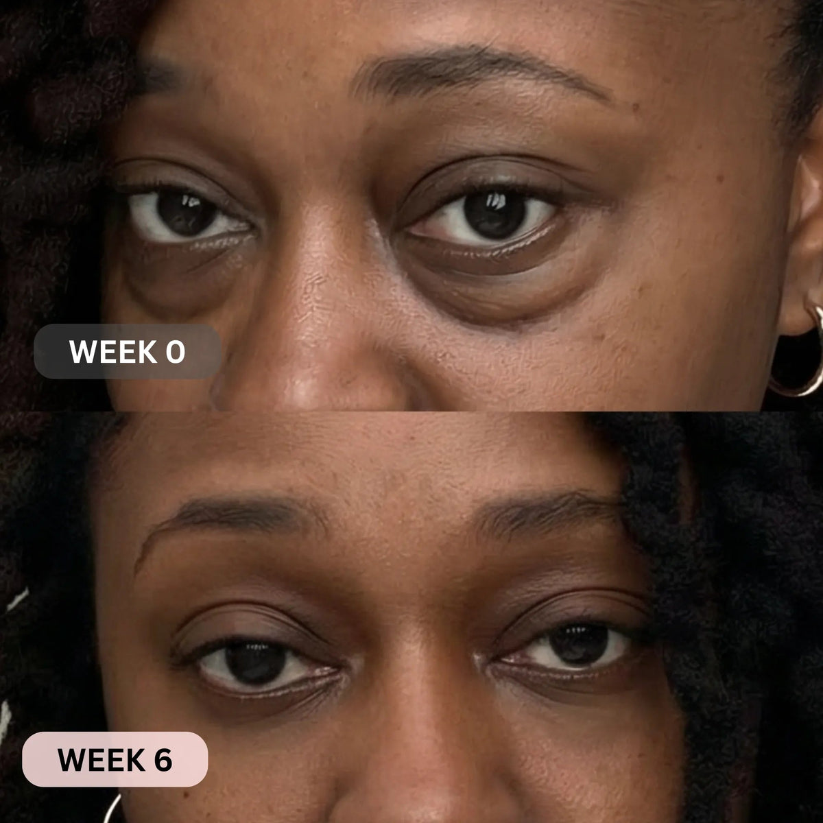 Dark circles before and after