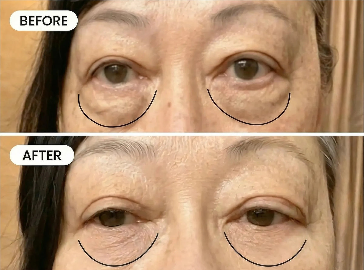 Before and after: puffiness drained after 8 treatments