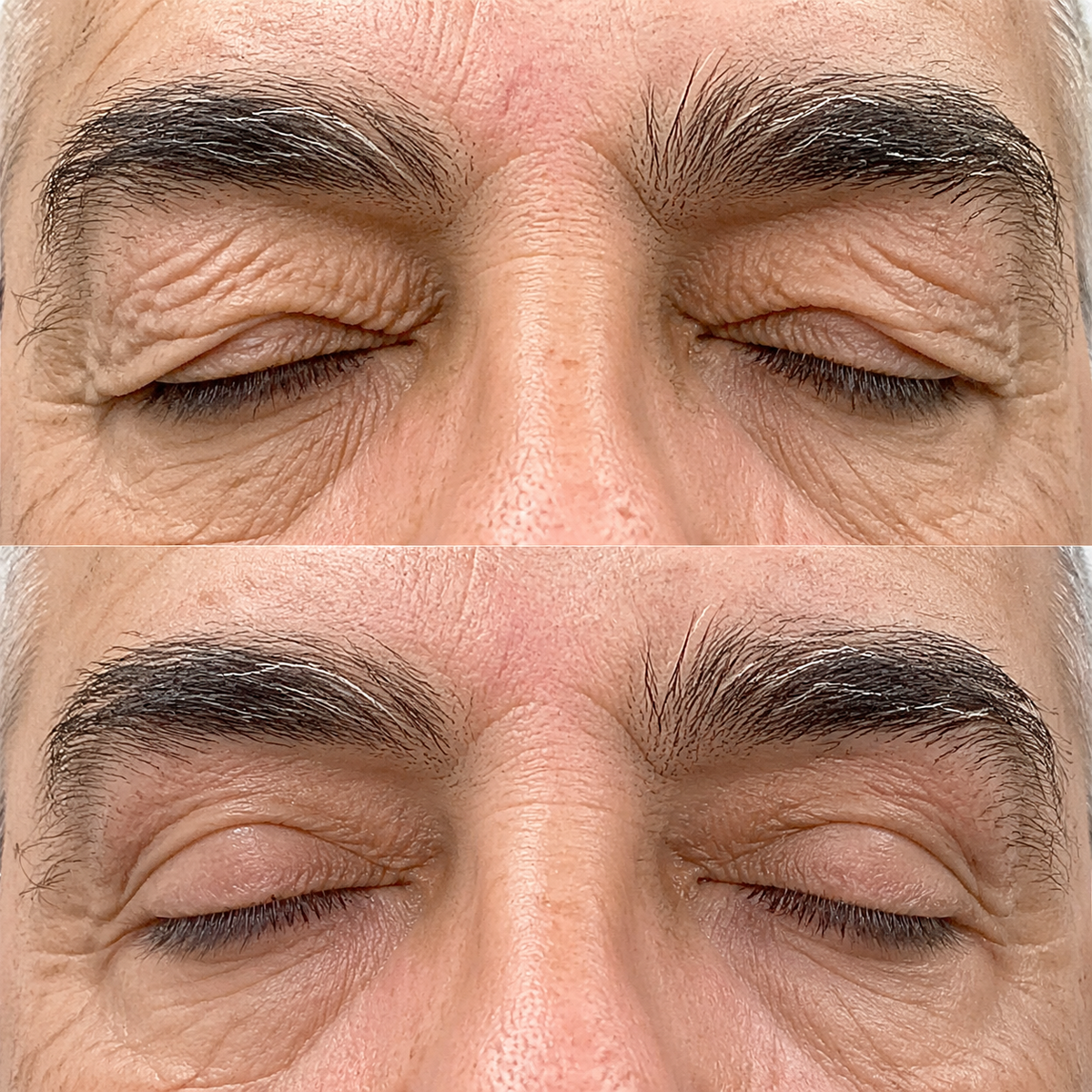 Before and after: hooded eyelids lifted