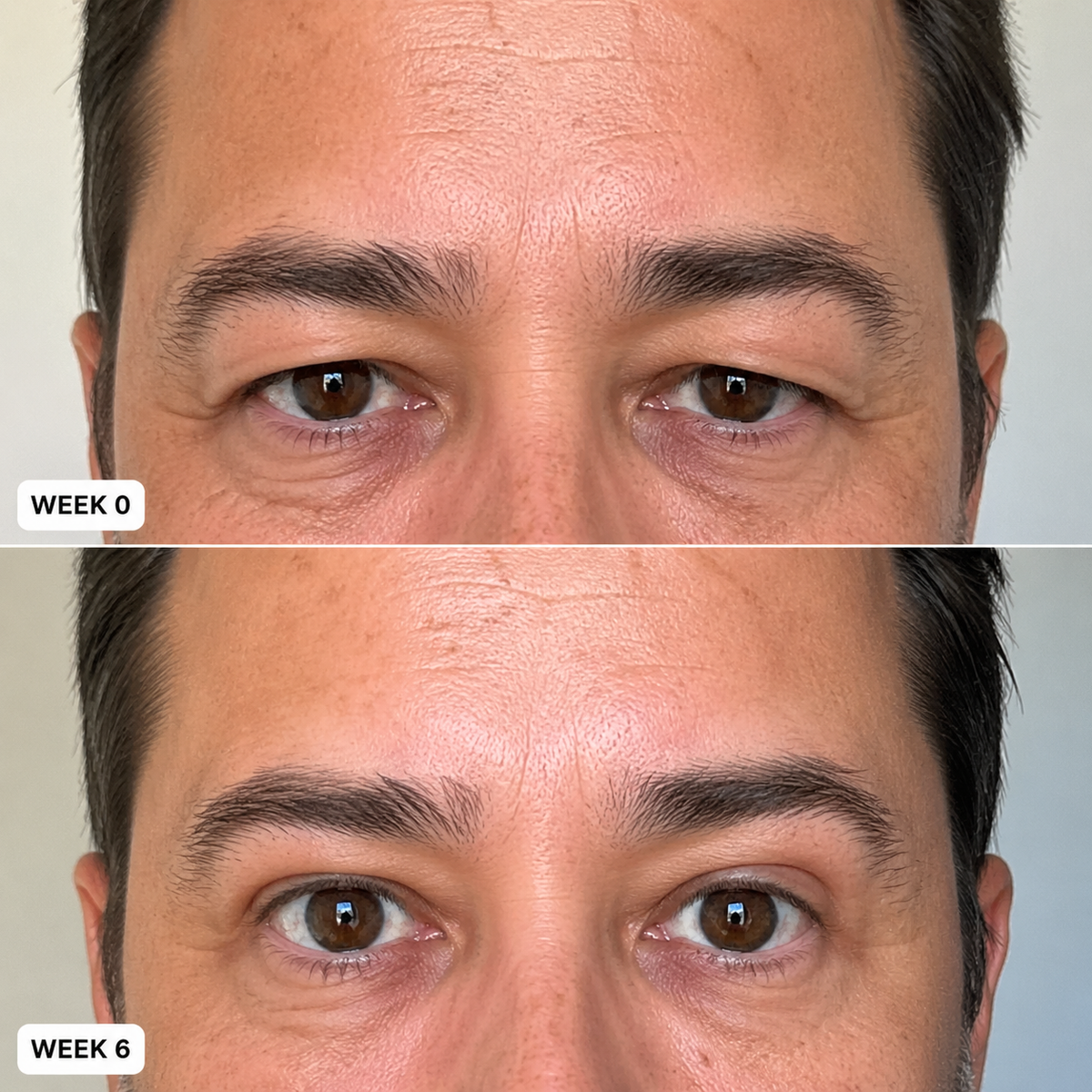 Week by week results of the micro-infusion system