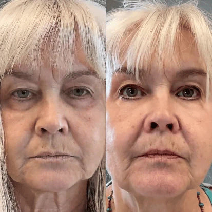 Side-by-side comparison of a woman's face before and after a procedure.