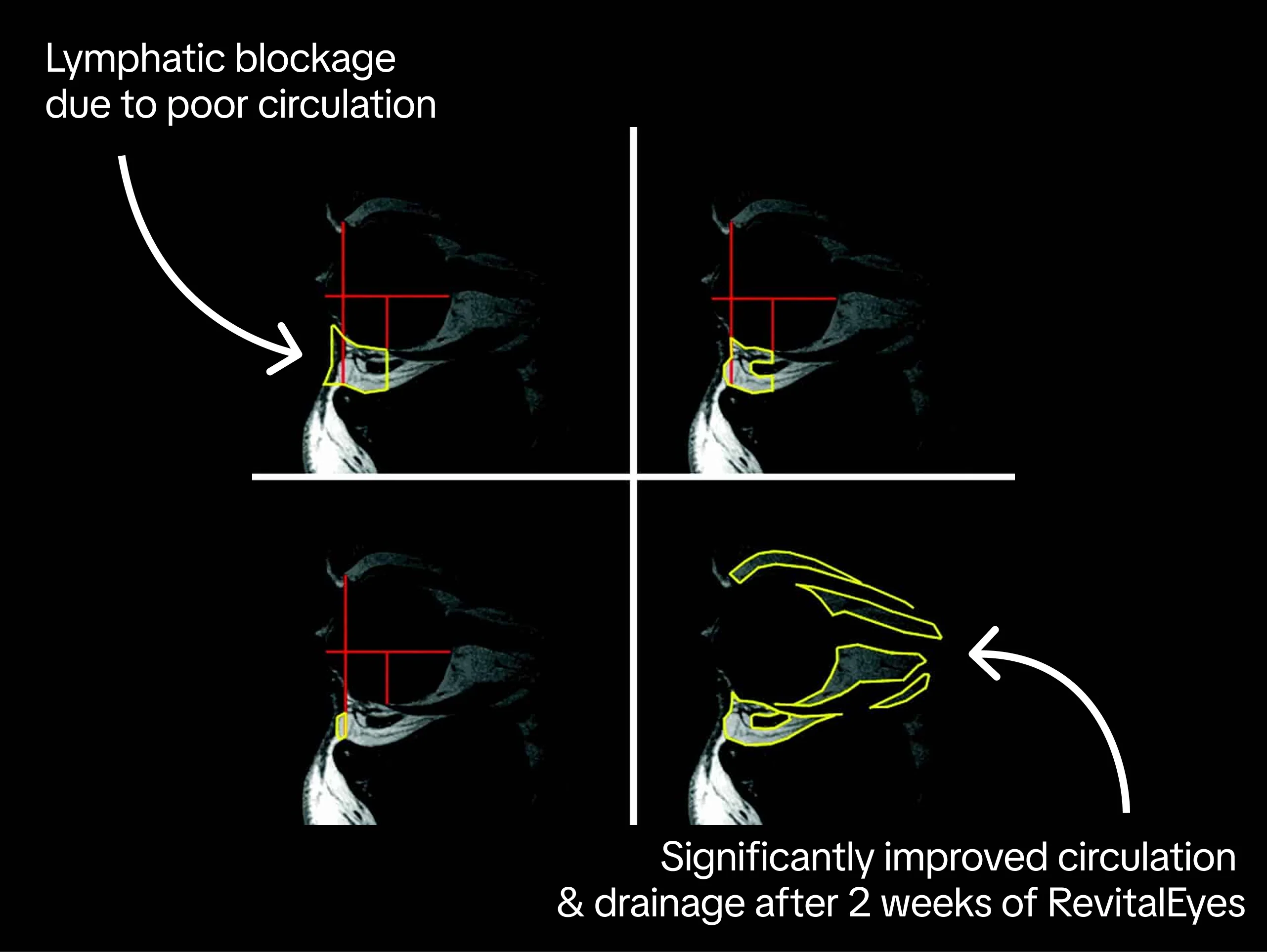 Diagram showing lymphatic blockage and improved circulation after RevitalEyes treatment.