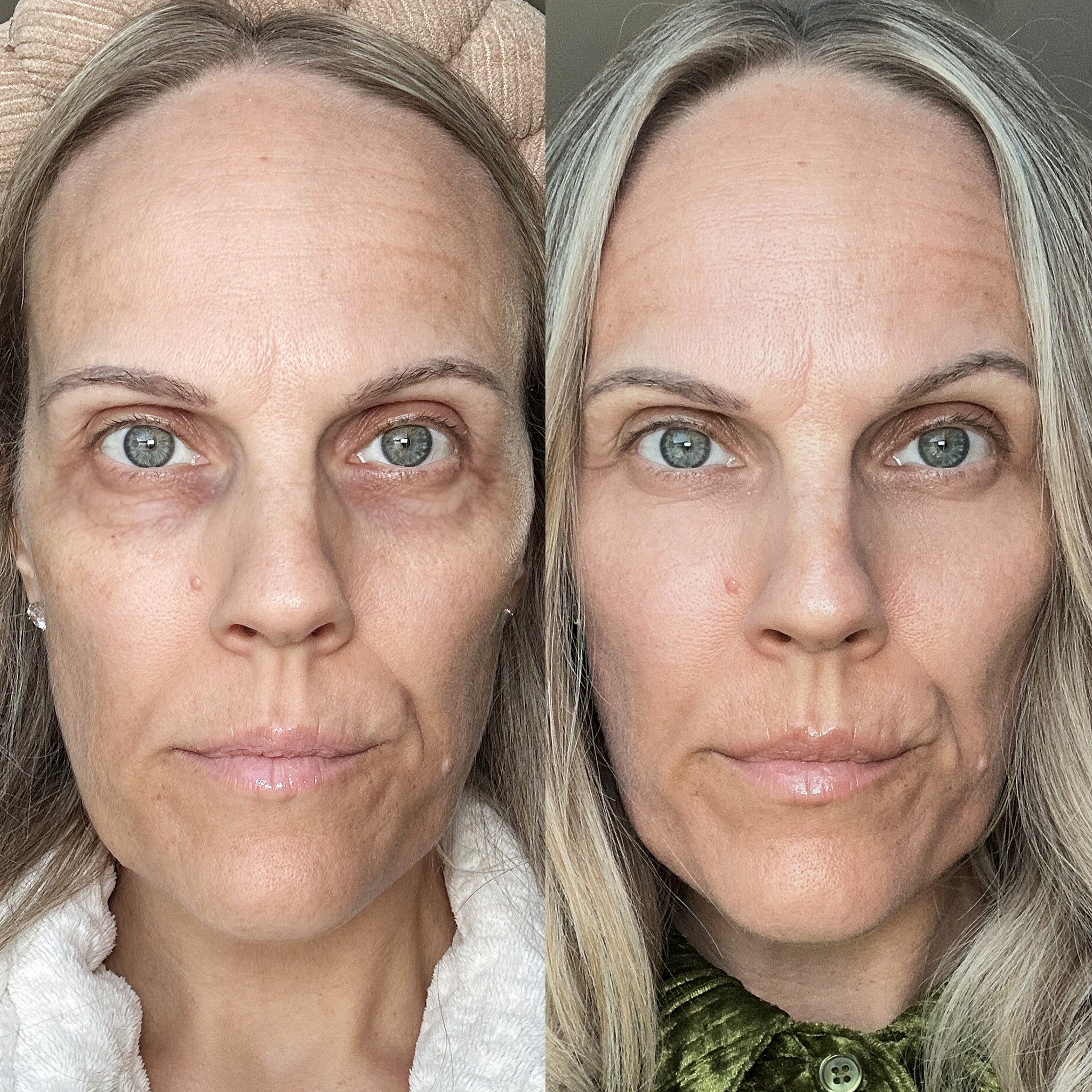 A clear vision of Old women's skin before and after treatment