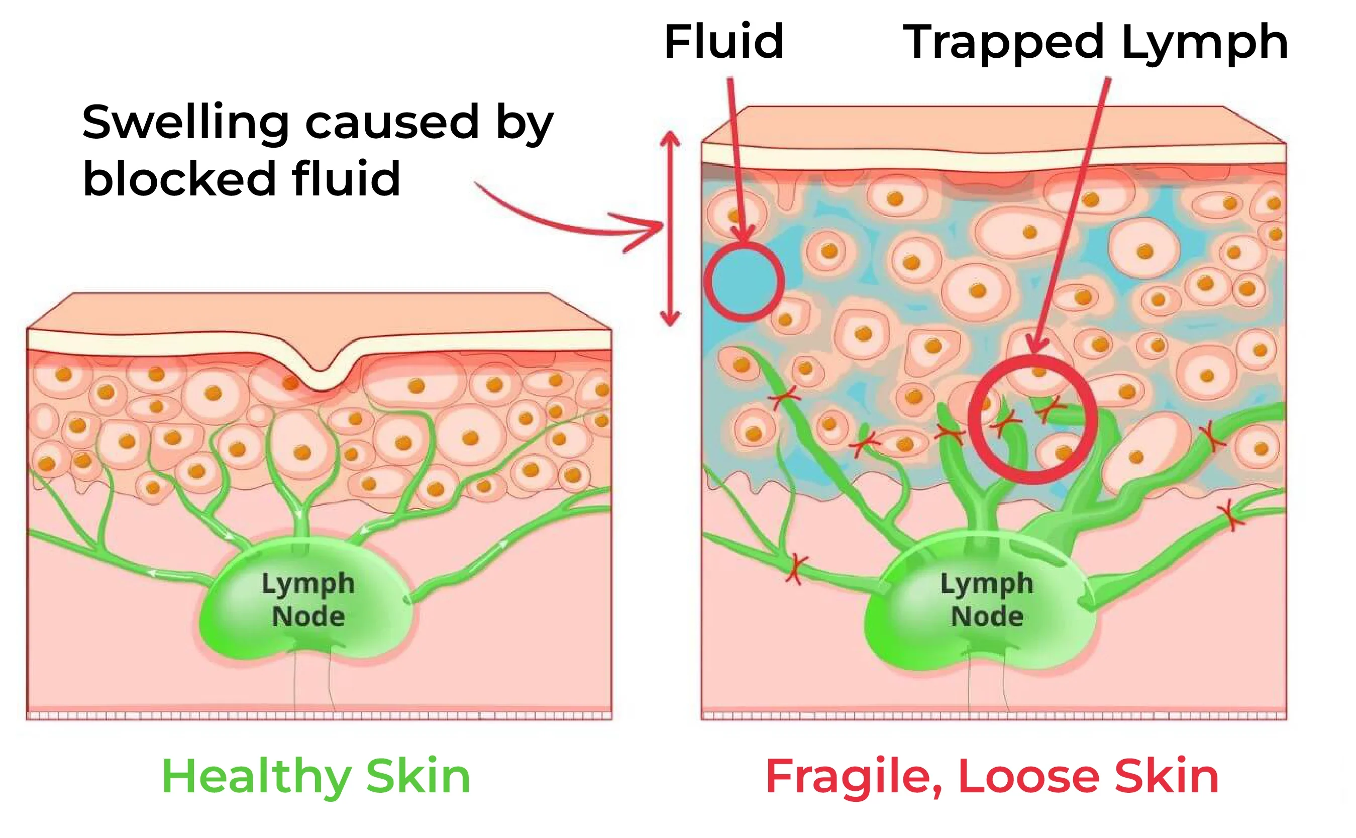 Diagram showing healthy skin with lymph nodes and fluid, compared to fragile, loose skin with trapped lymph.