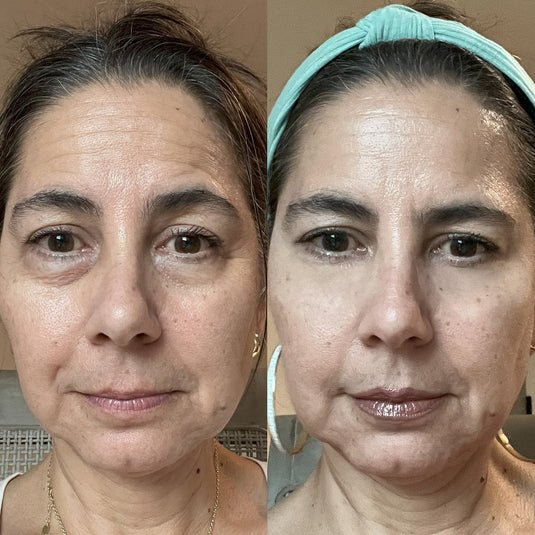 RevitalEyes® 2 - in - 1 Red Light + EMS Under - Eye Therapy - Botanique Paris